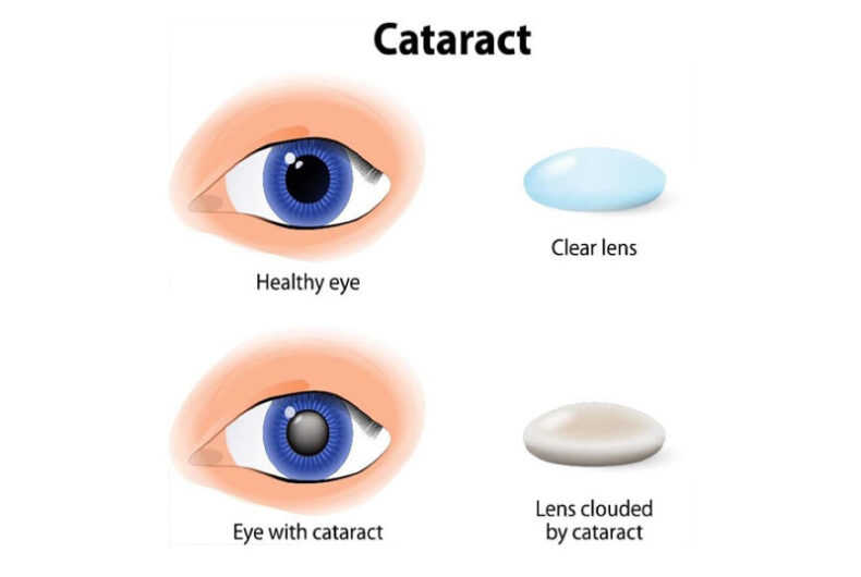 Cataracts