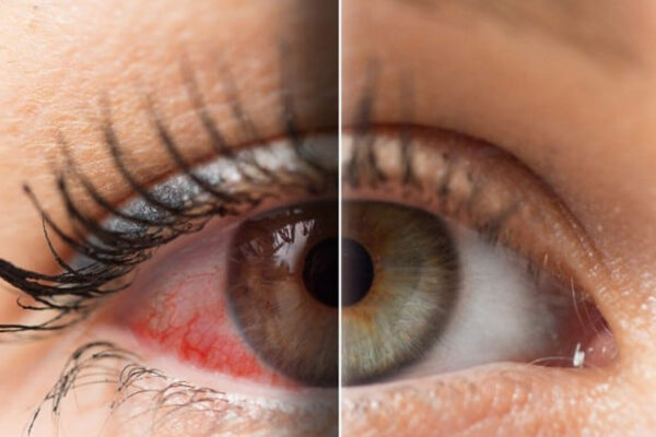 Dry Eyes Bothering You Dry Eyes Bothering You